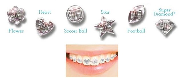 Colorful style to your braces!